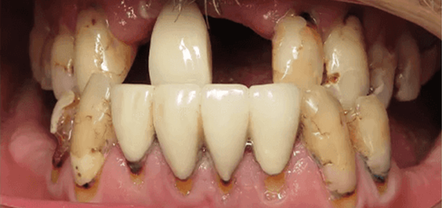 Smile Makeover before at Dental Design Studios (Dentista) in Nashville, TN