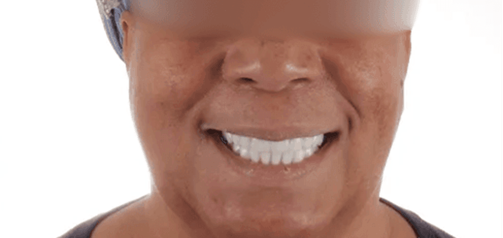 Dental Design Studios (Dentista) smile makeover after — Nashville, TN