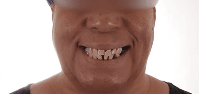 Smile Makeover before at Dental Design Studios (Dentista) in Nashville, TN