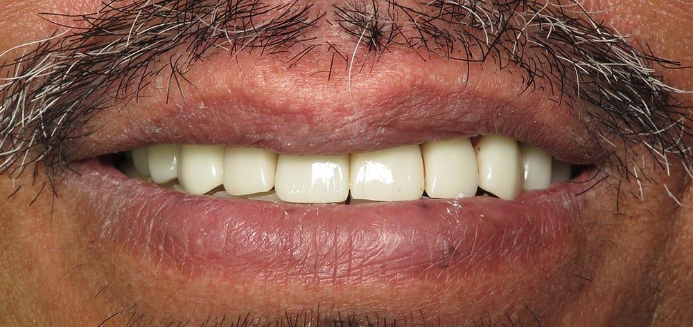 Dental Design Studios (Dentista) smile makeover after — Nashville, TN