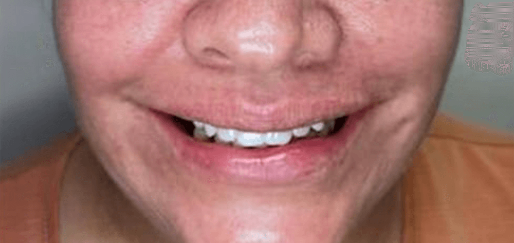 Dental Design Studios (Dentista) smile makeover after — Nashville, TN