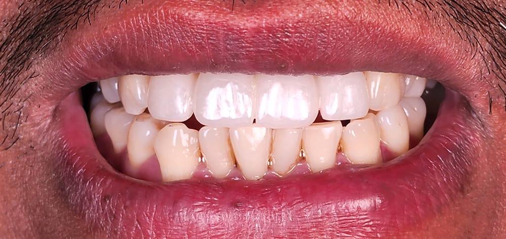 Dental Design Studios (Dentista) smile makeover after — Nashville, TN