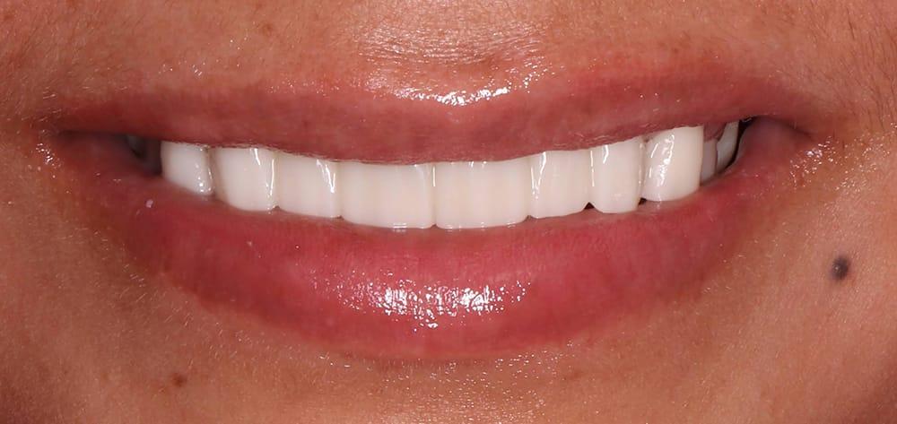 Dental Design Studios (Dentista) smile makeover after — Nashville, TN