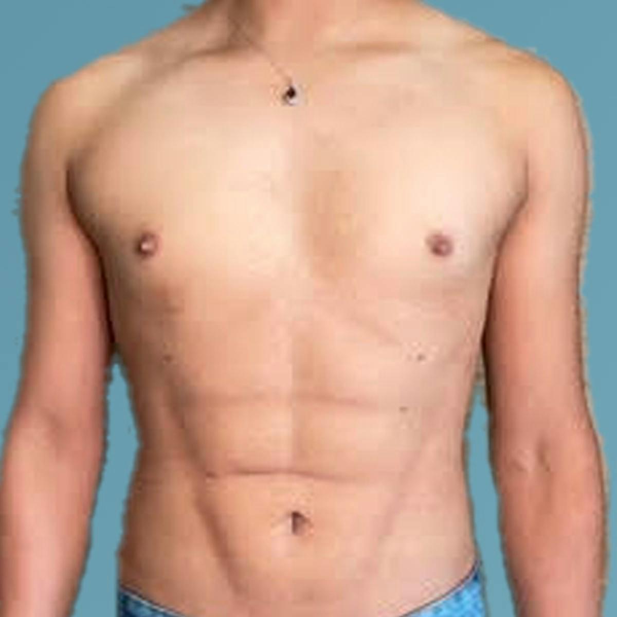 Dr. Courtney liposuction after — Houston, TX