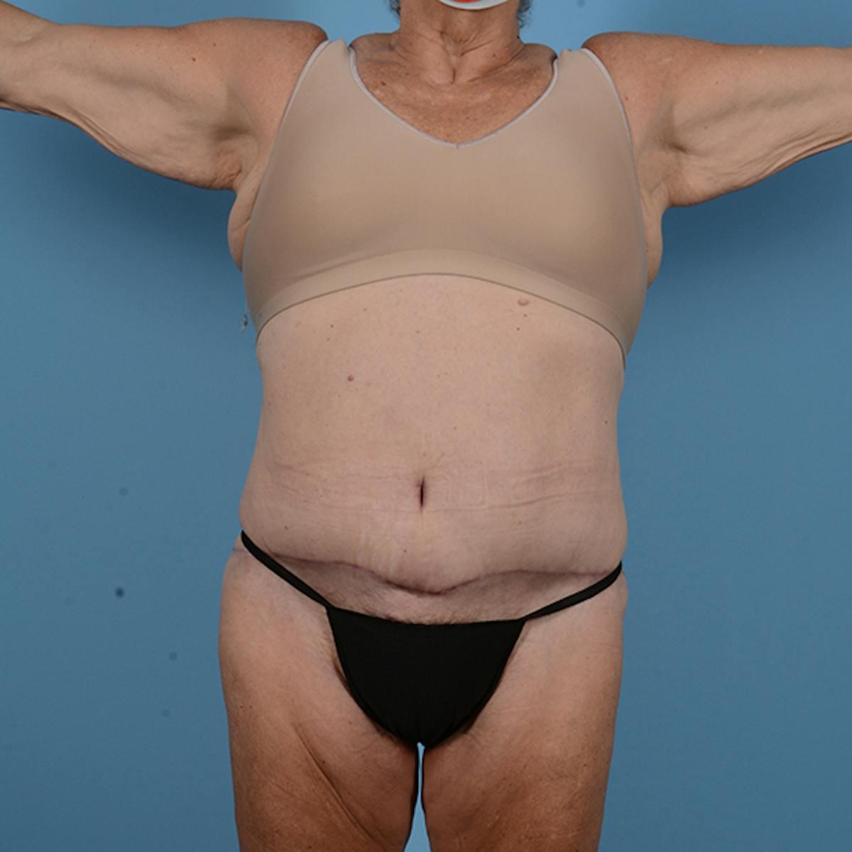 Dr. Courtney tummy tuck after — Houston, TX