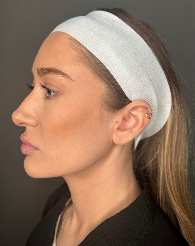 Neck Lift after at Dr. Courtney in Houston, TX