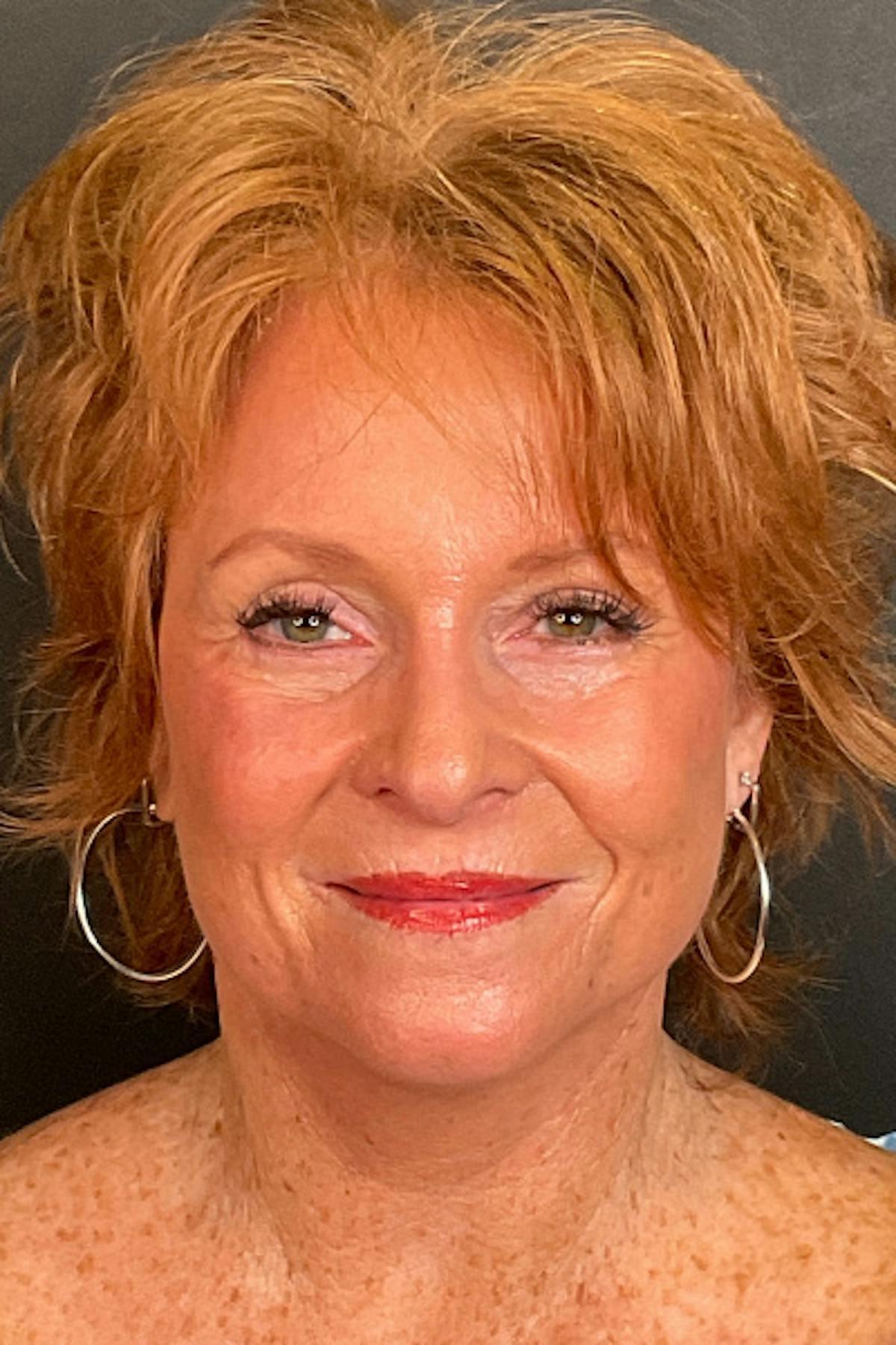 Dr. Courtney facelift after — Houston, TX