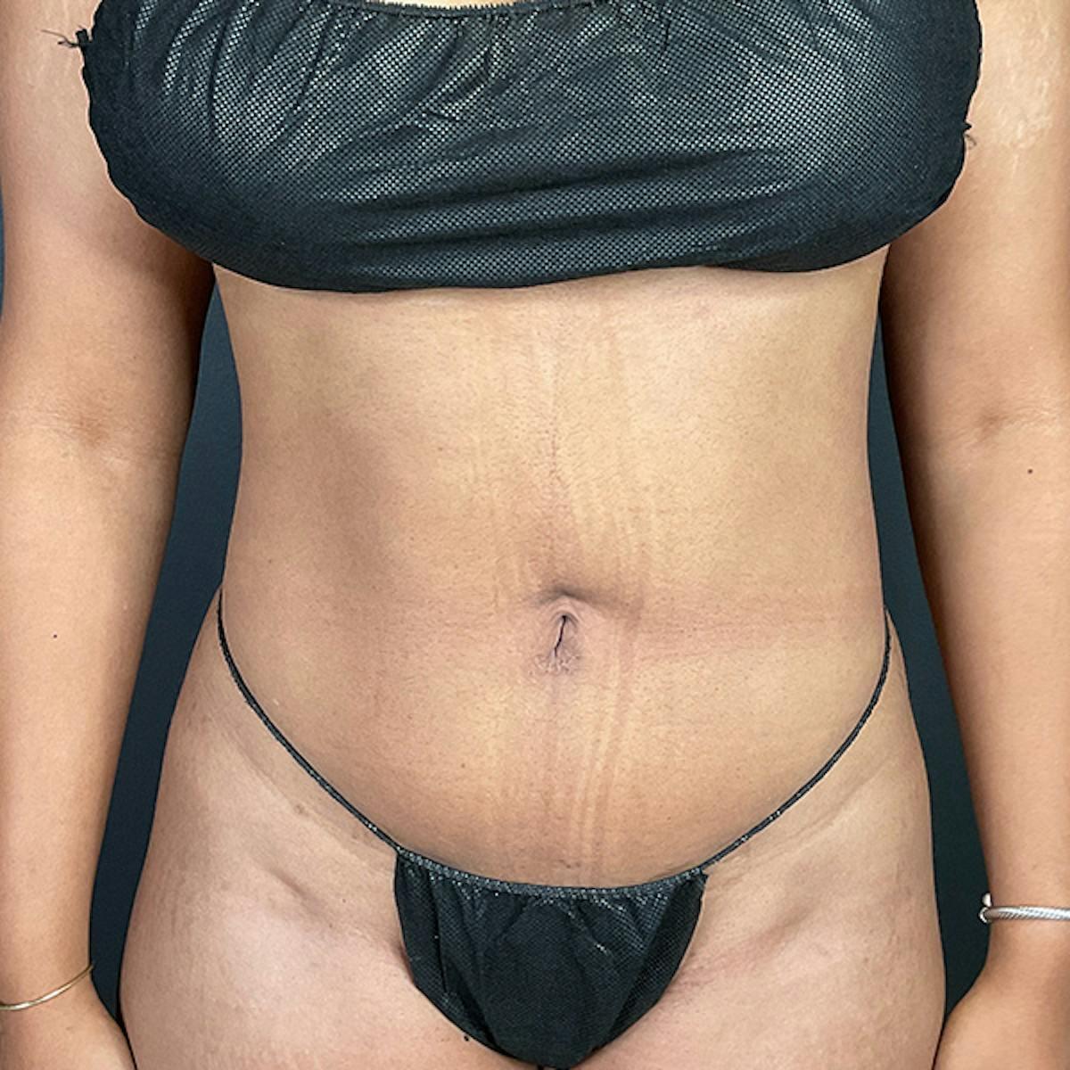 Dr. Courtney liposuction after — Houston, TX