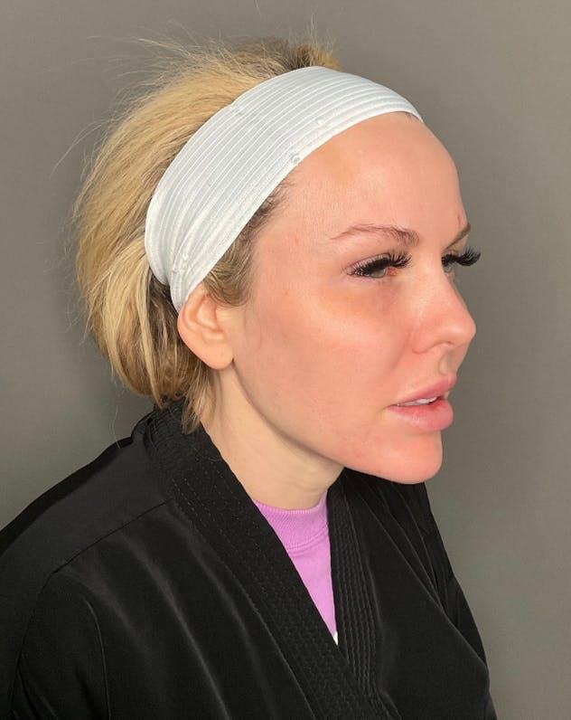 Neck Lift after at Dr. Courtney in Houston, TX