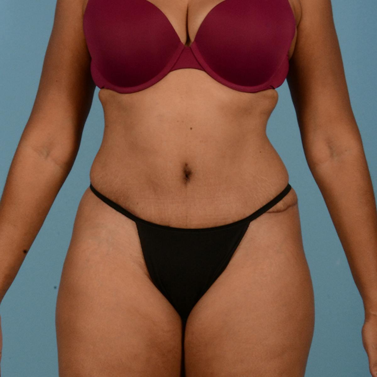 Dr. Courtney liposuction after — Houston, TX