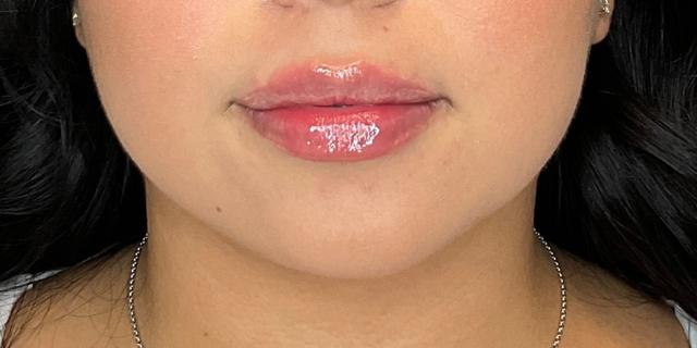 Lip Filler result at Dr. Courtney in Houston, TX