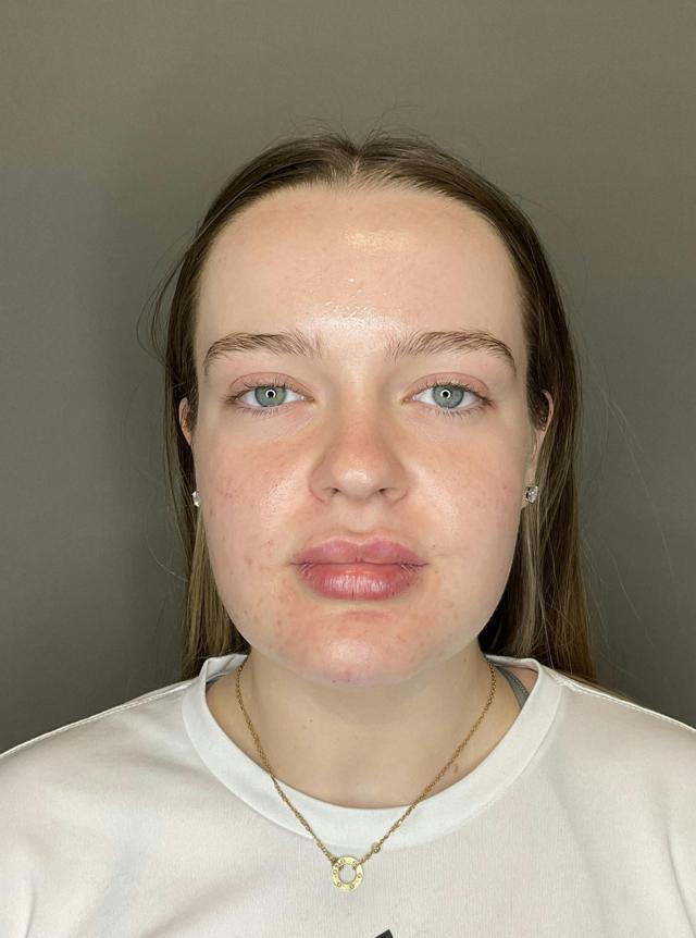 Lip Filler after at Dr. Courtney in Houston, TX