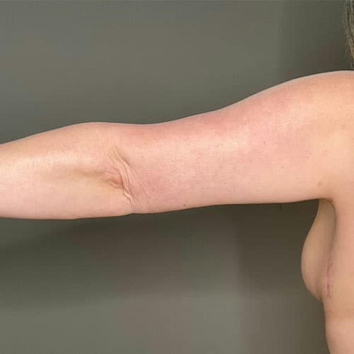 Dr. Courtney arm lift after — Houston, TX