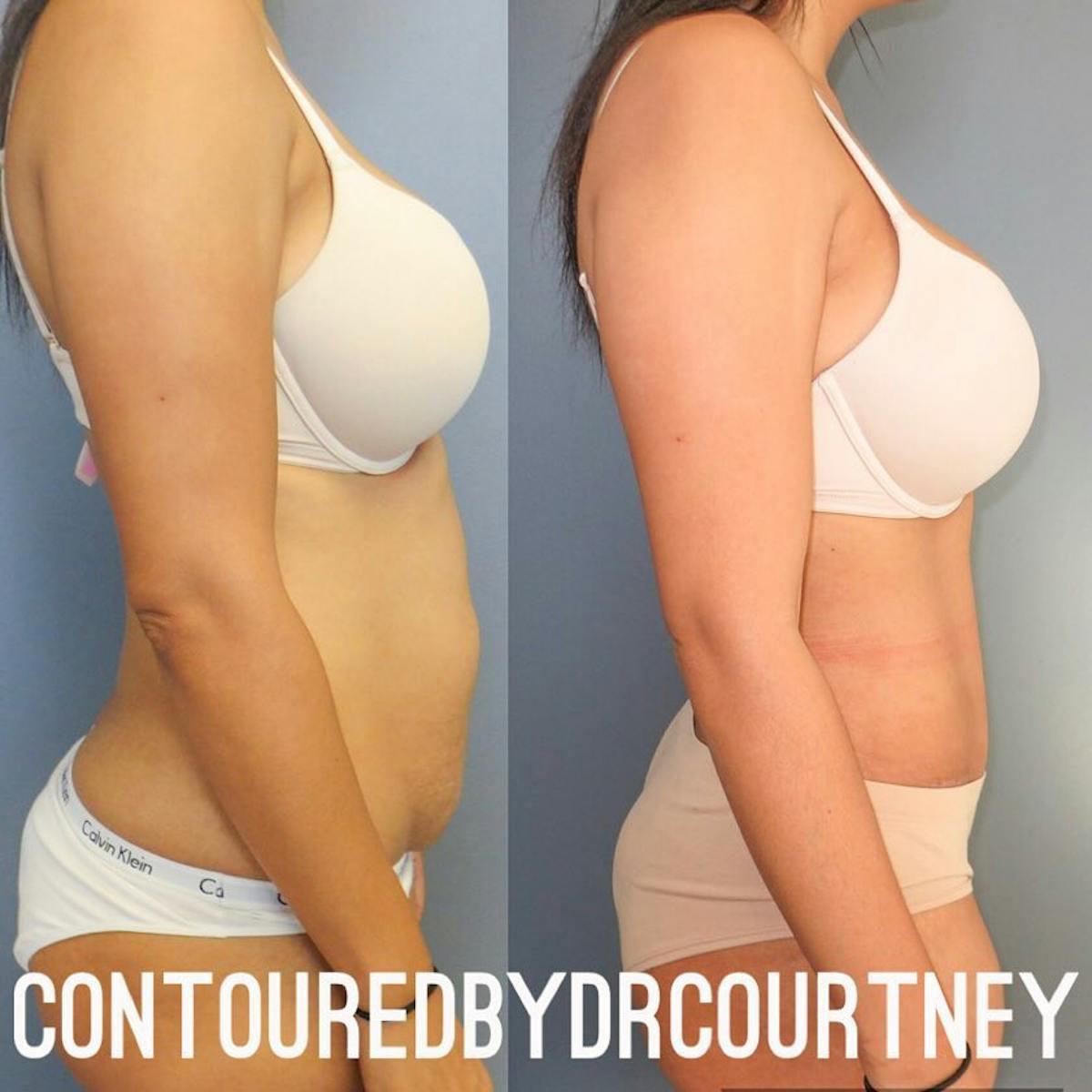 Dr. Courtney tummy tuck after — Houston, TX