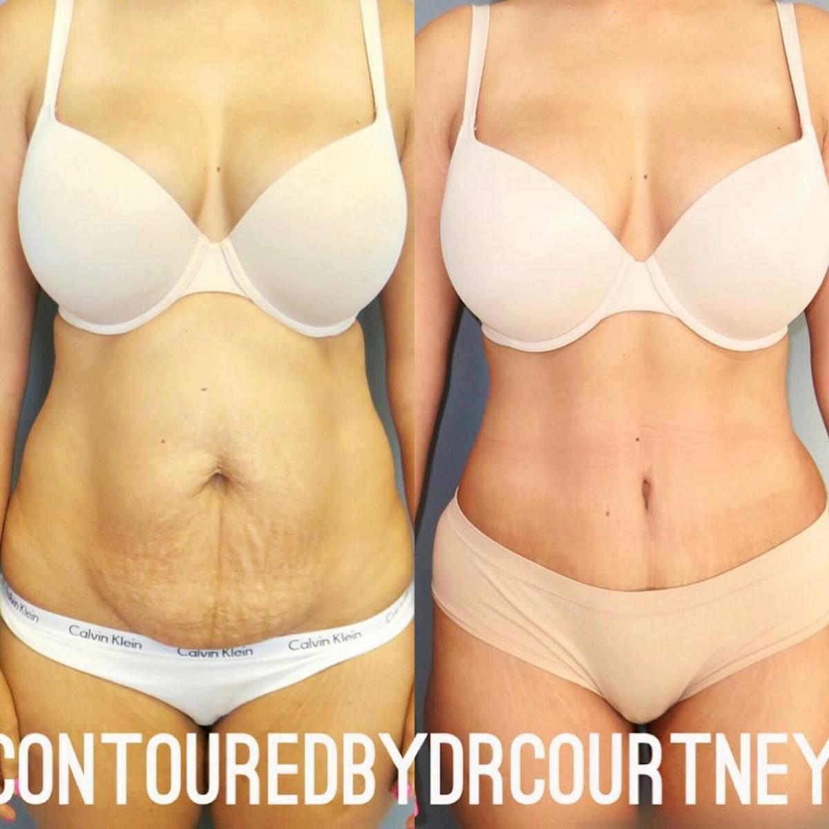 Dr. Courtney tummy tuck result — Houston, TX