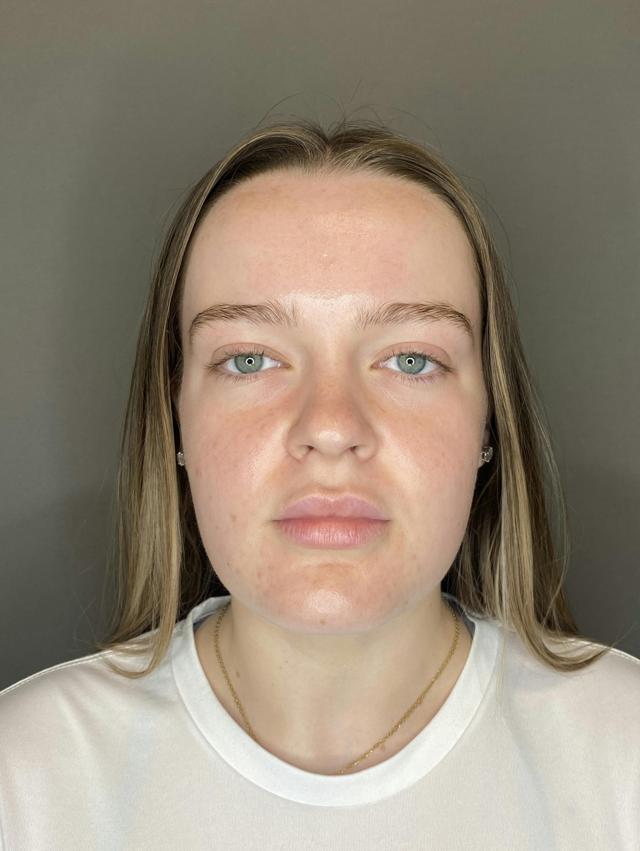 Lip Filler before at Dr. Courtney in Houston, TX