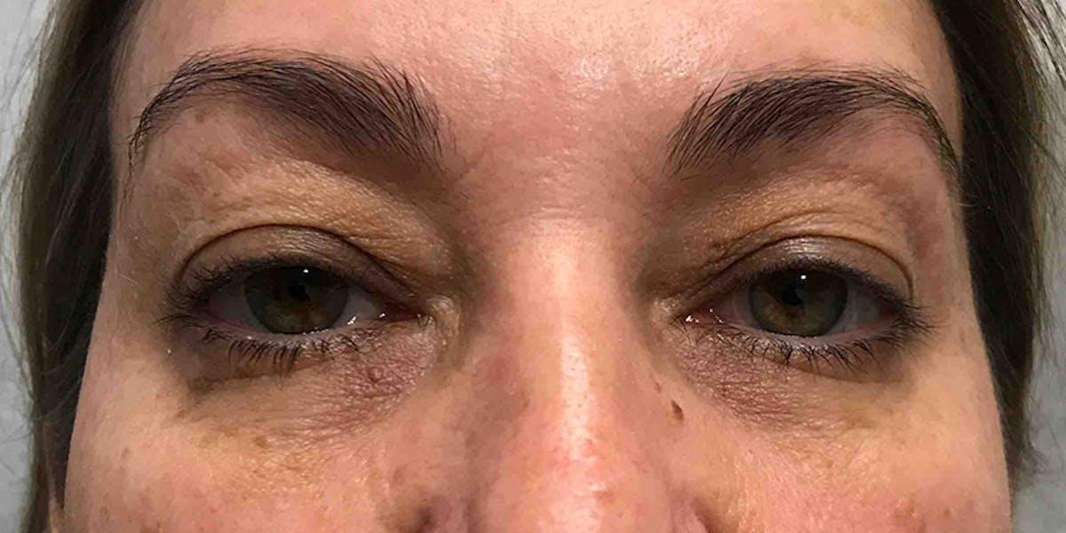 Dr. Courtney blepharoplasty after — Houston, TX