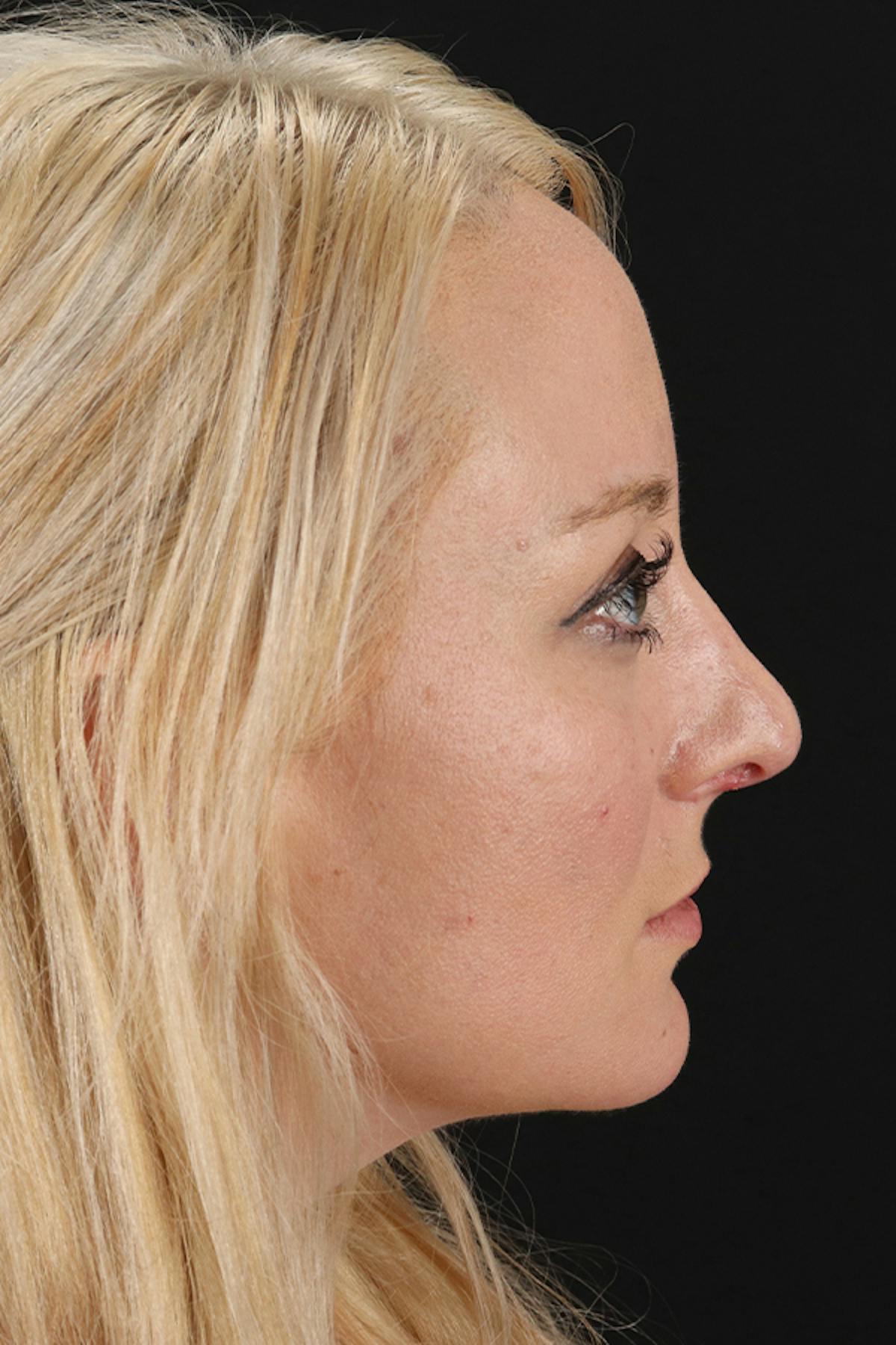 Dr. Courtney rhinoplasty after — Houston, TX