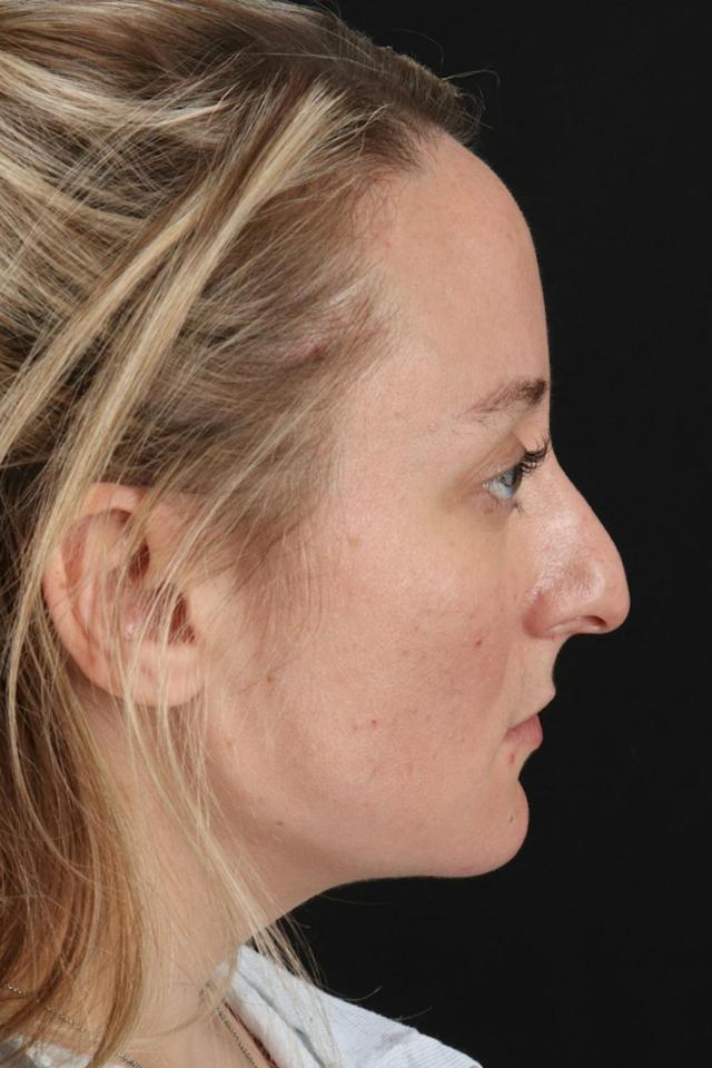 Liquid Rhinoplasty before at Dr. Courtney in Houston, TX