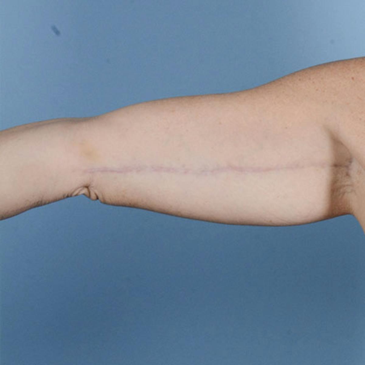 Dr. Courtney arm lift after — Houston, TX