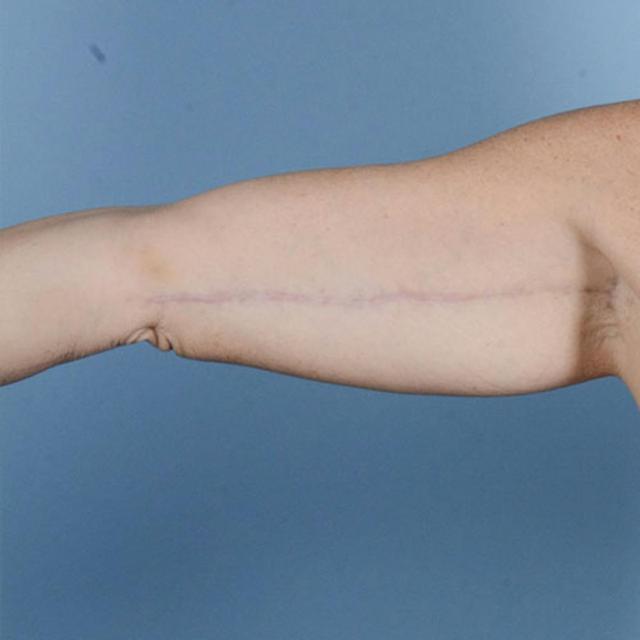 Arm Lift after at Dr. Courtney in Houston, TX