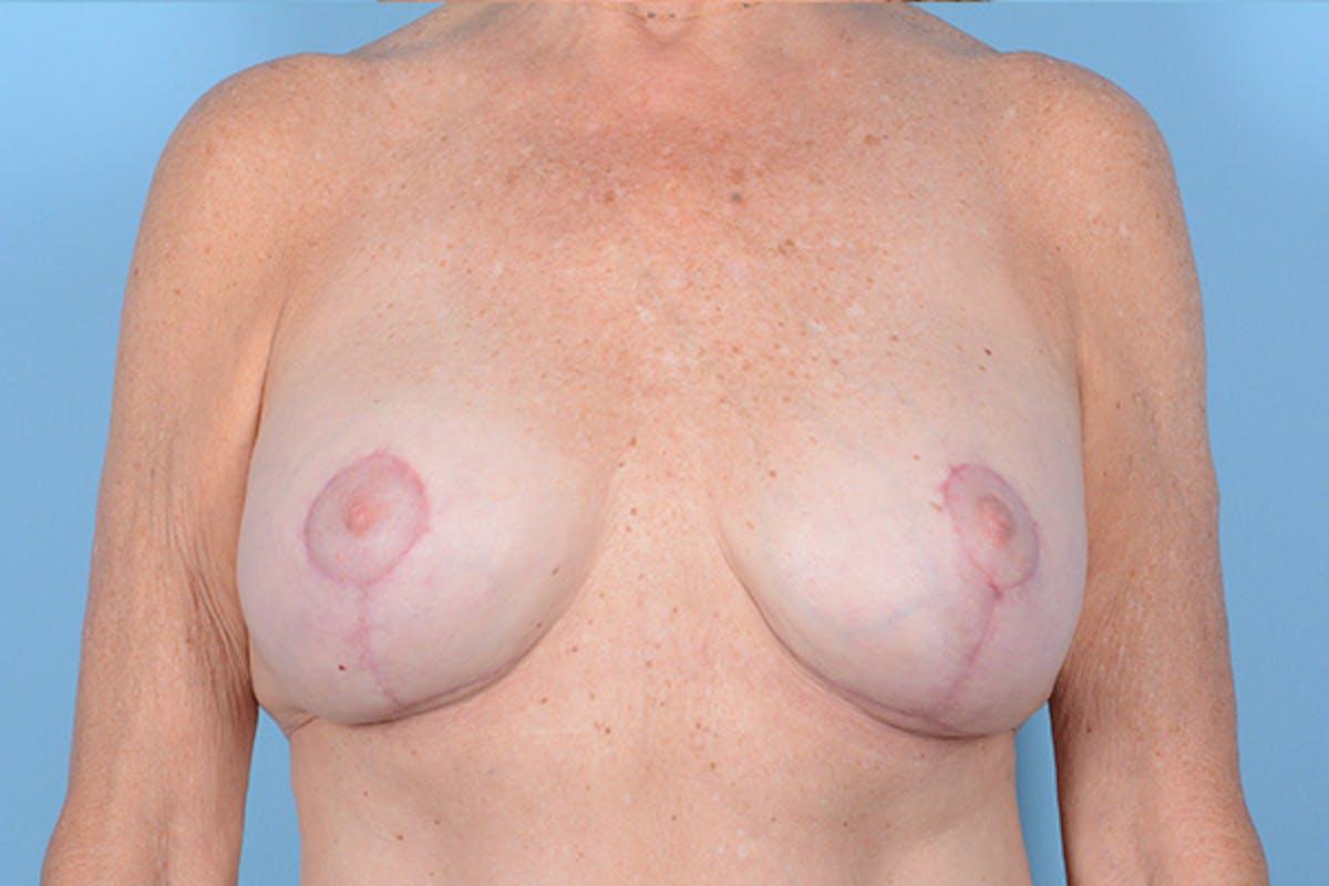 Dr. Courtney breast augmentation after — Houston, TX