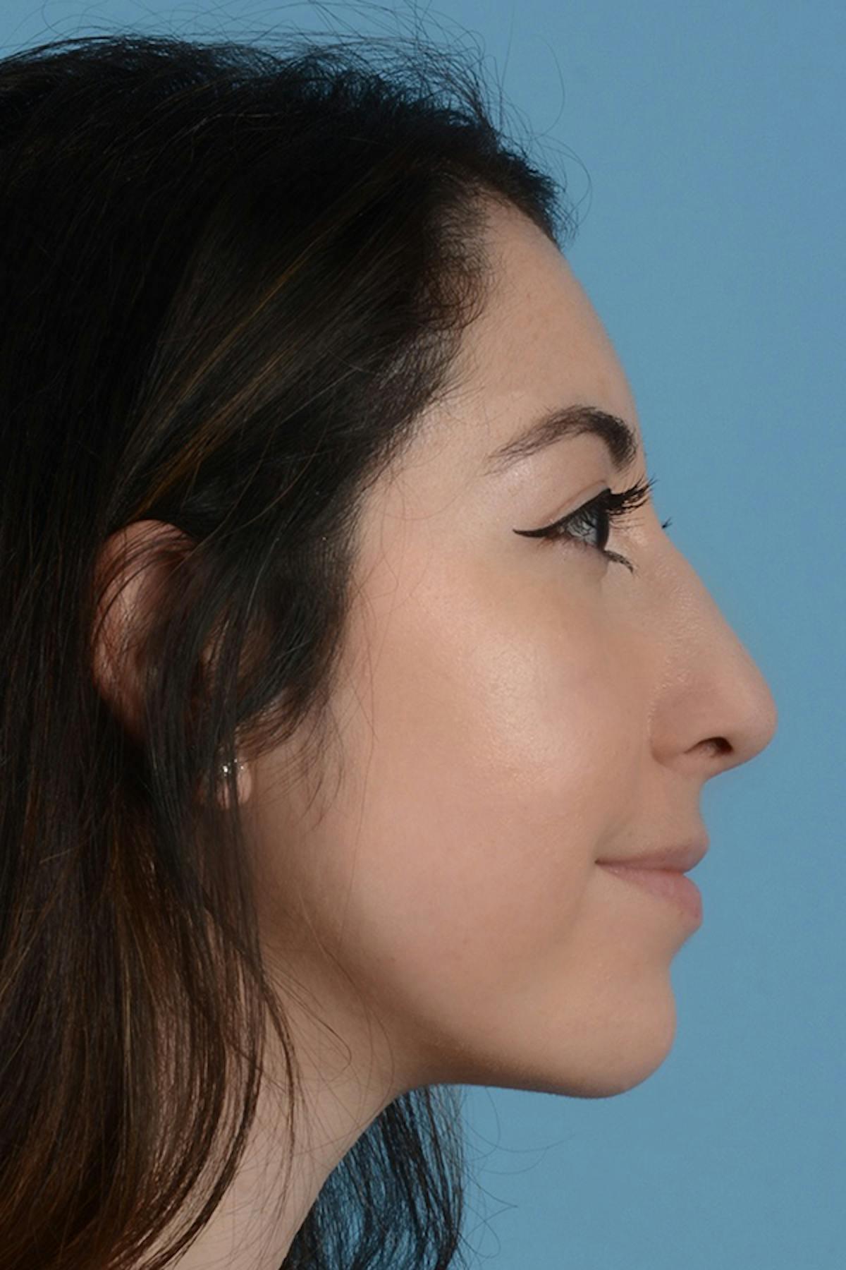 Dr. Courtney rhinoplasty after — Houston, TX
