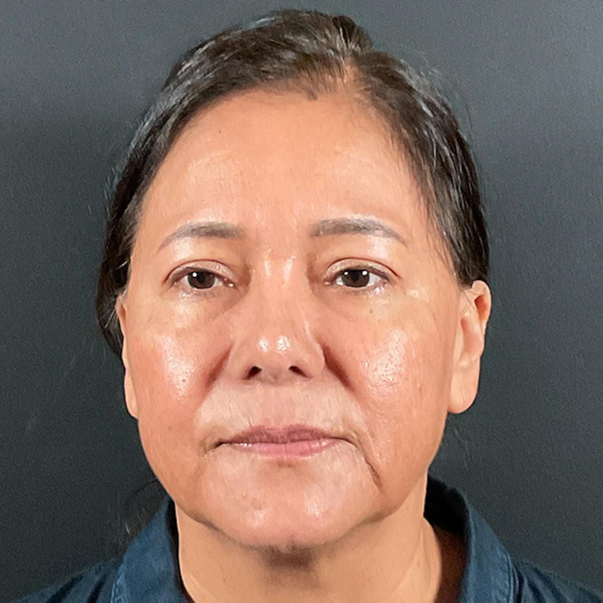 Dr. Courtney blepharoplasty after — Houston, TX