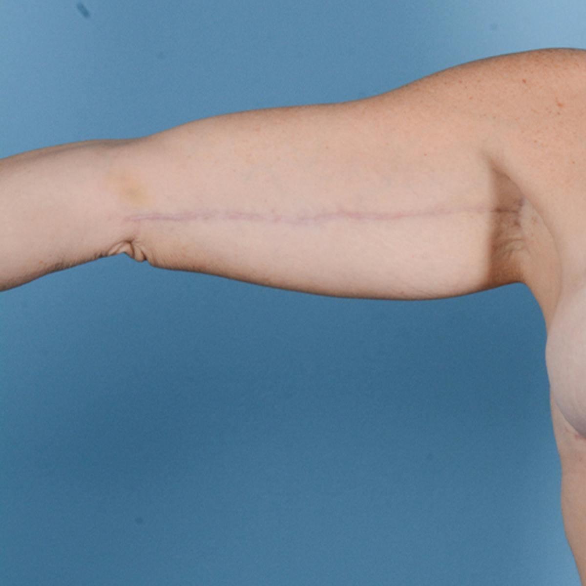Dr. Courtney arm lift after — Houston, TX