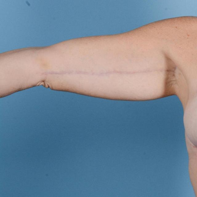 Arm Lift after at Dr. Courtney in Houston, TX