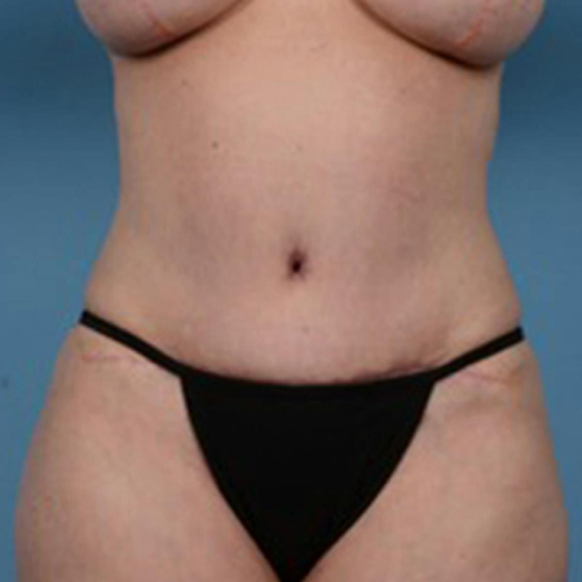 Dr. Courtney liposuction after — Houston, TX