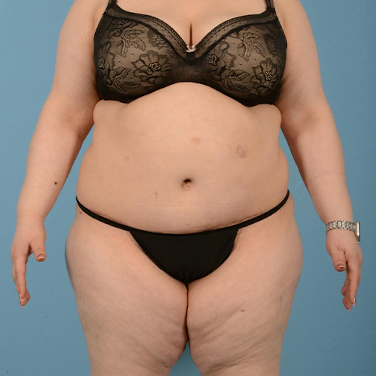 Dr. Courtney tummy tuck after — Houston, TX