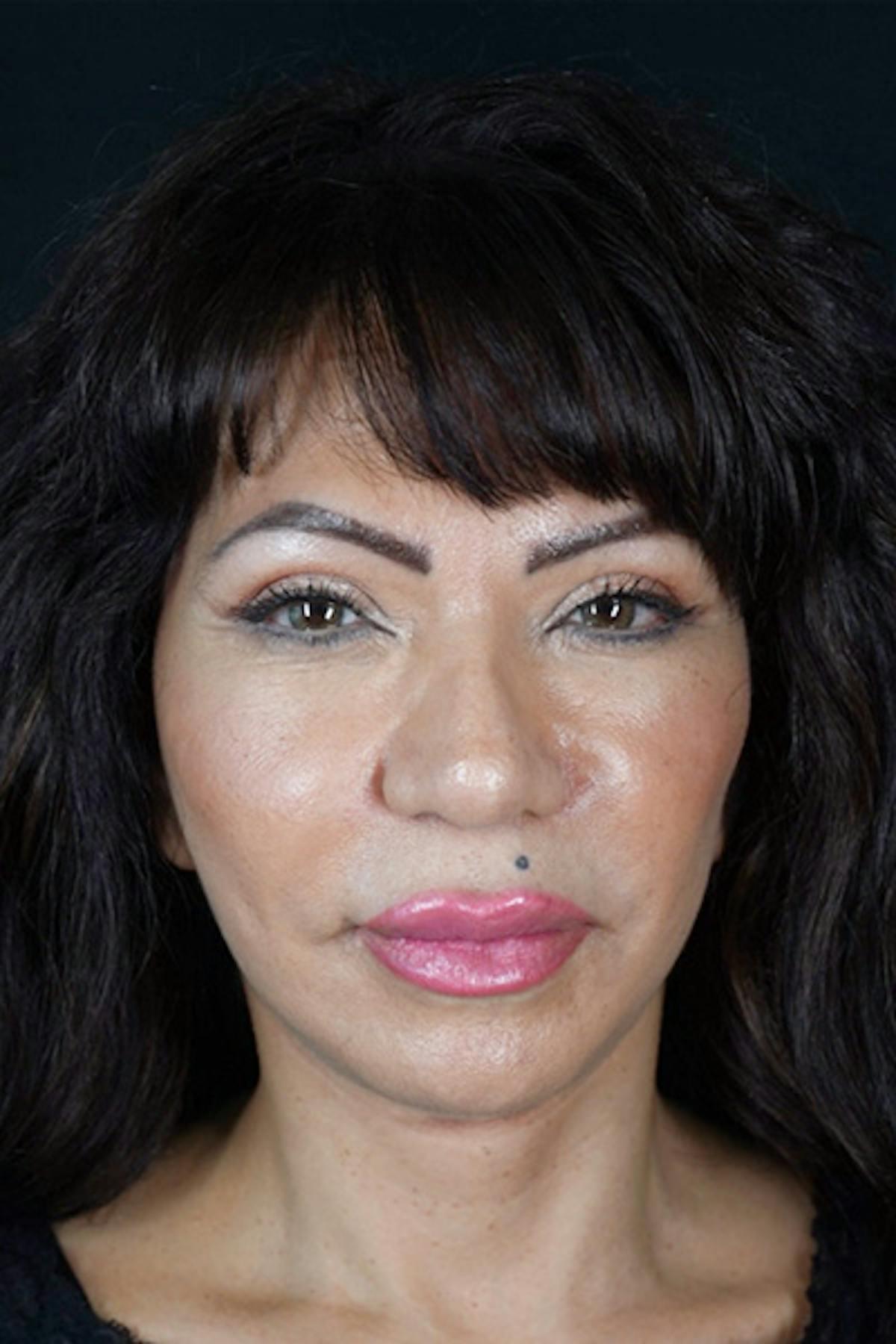 Dr. Courtney facelift after — Houston, TX