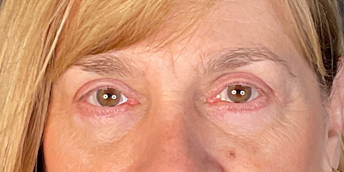 Dr. Courtney blepharoplasty after — Houston, TX