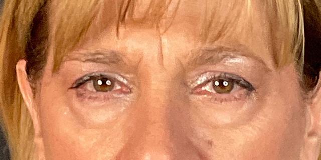Blepharoplasty before at Dr. Courtney in Houston, TX