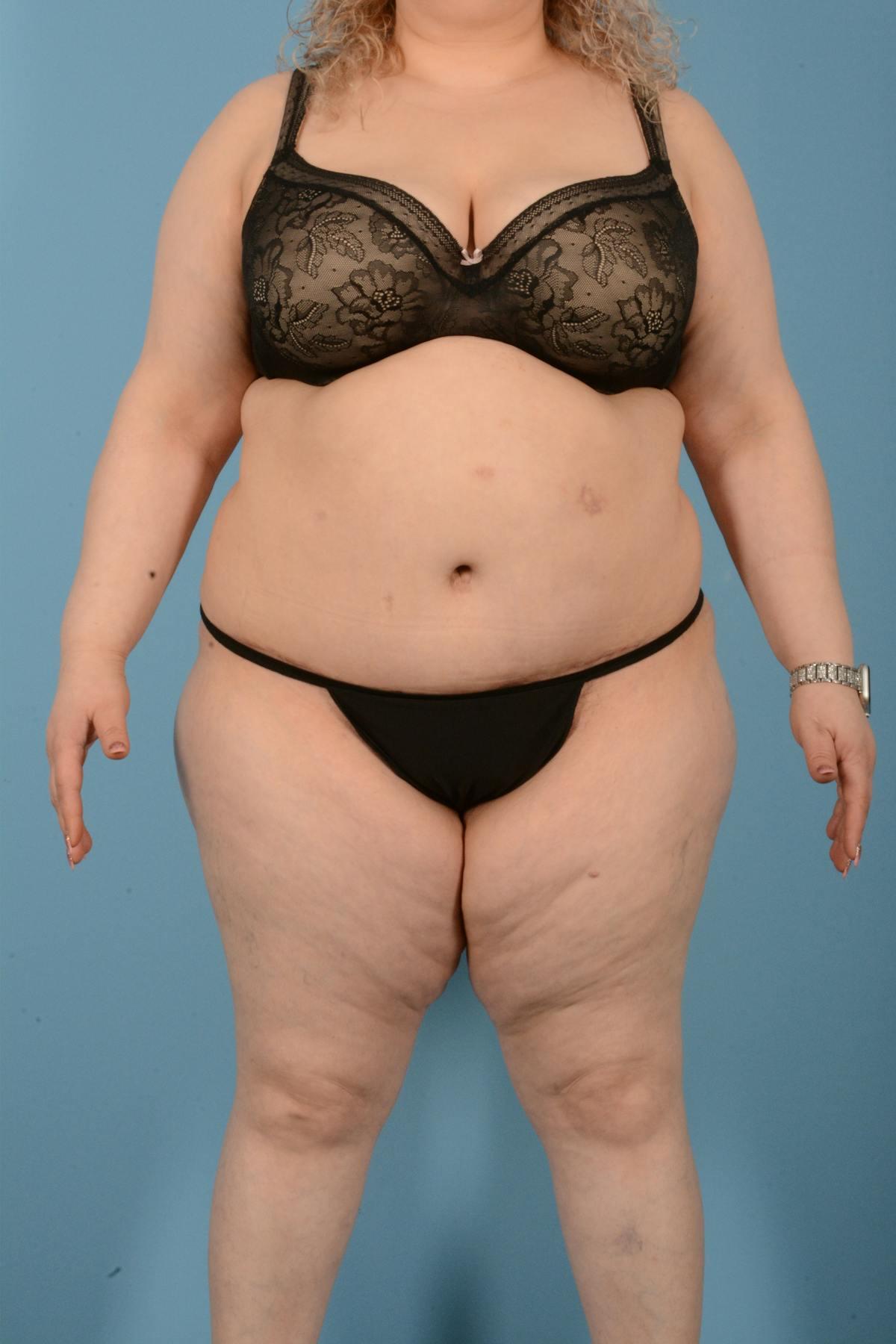 Dr. Courtney tummy tuck after — Houston, TX