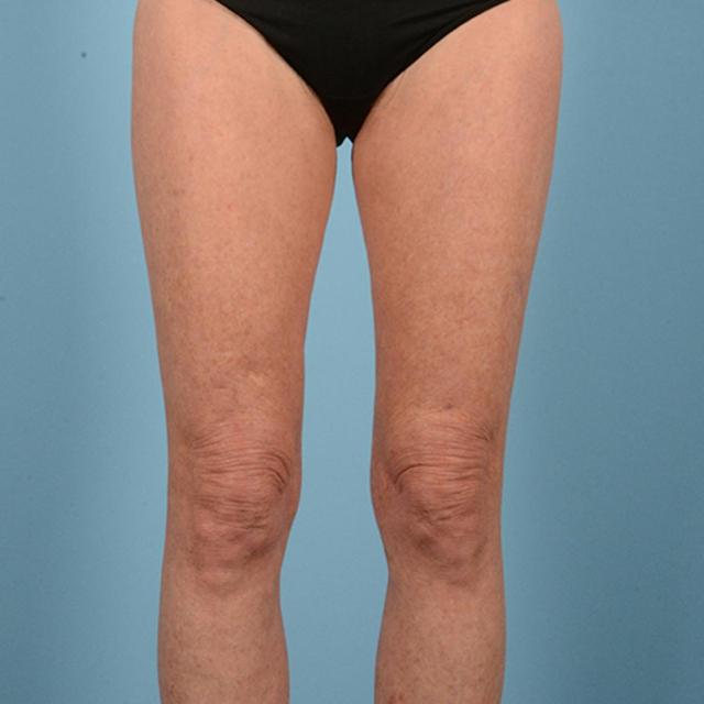 Liposuction after at Dr. Courtney in Houston, TX
