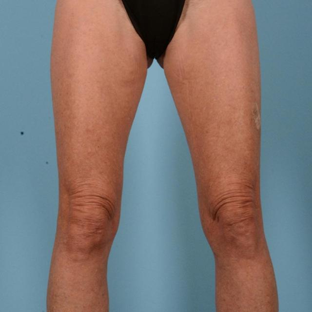 Liposuction before at Dr. Courtney in Houston, TX