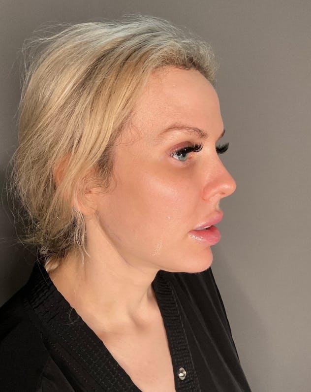 Neck Lift before at Dr. Courtney in Houston, TX