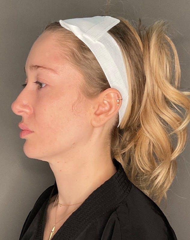 Neck Lift before at Dr. Courtney in Houston, TX