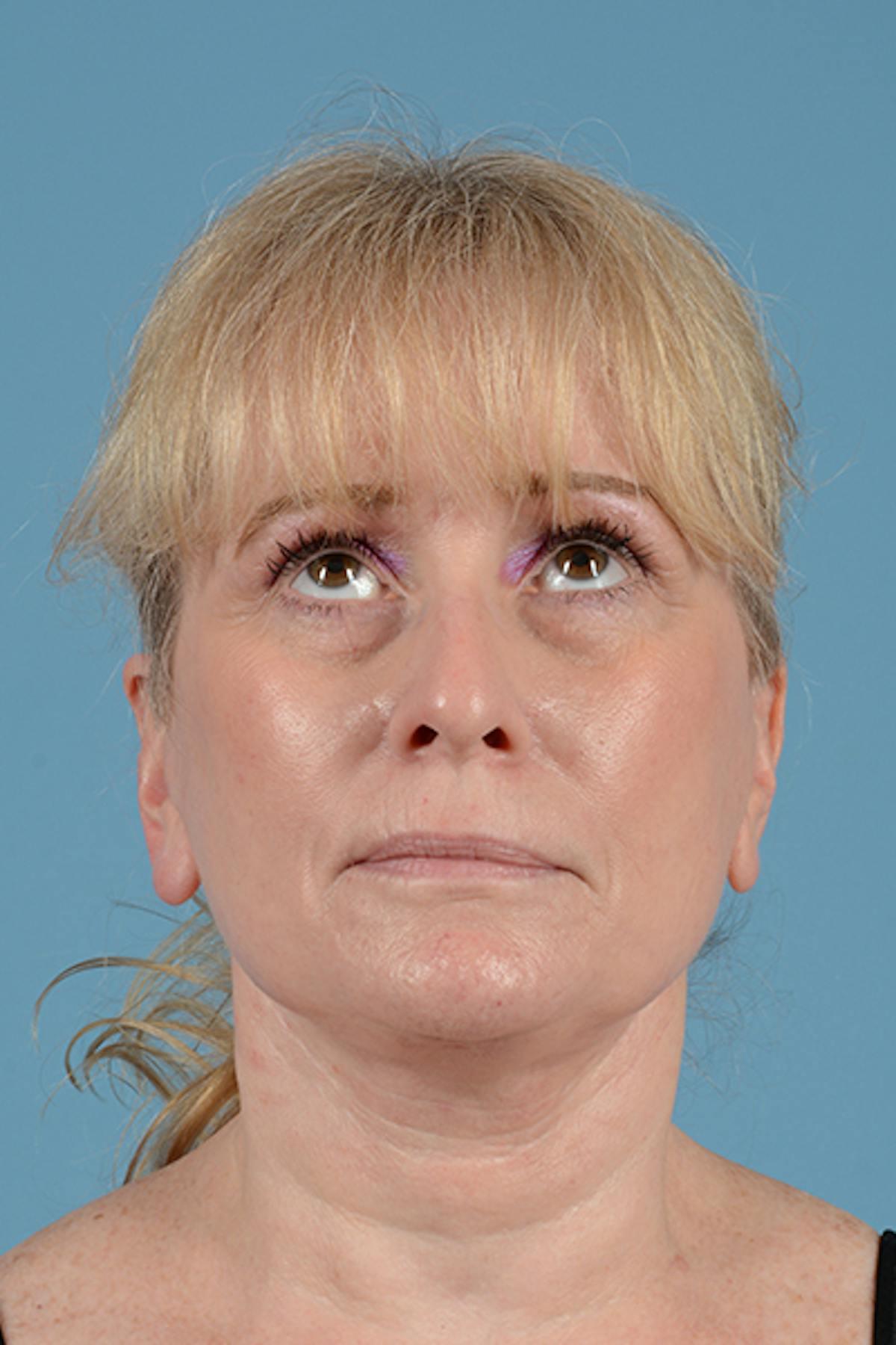 Dr. Courtney facelift after — Houston, TX
