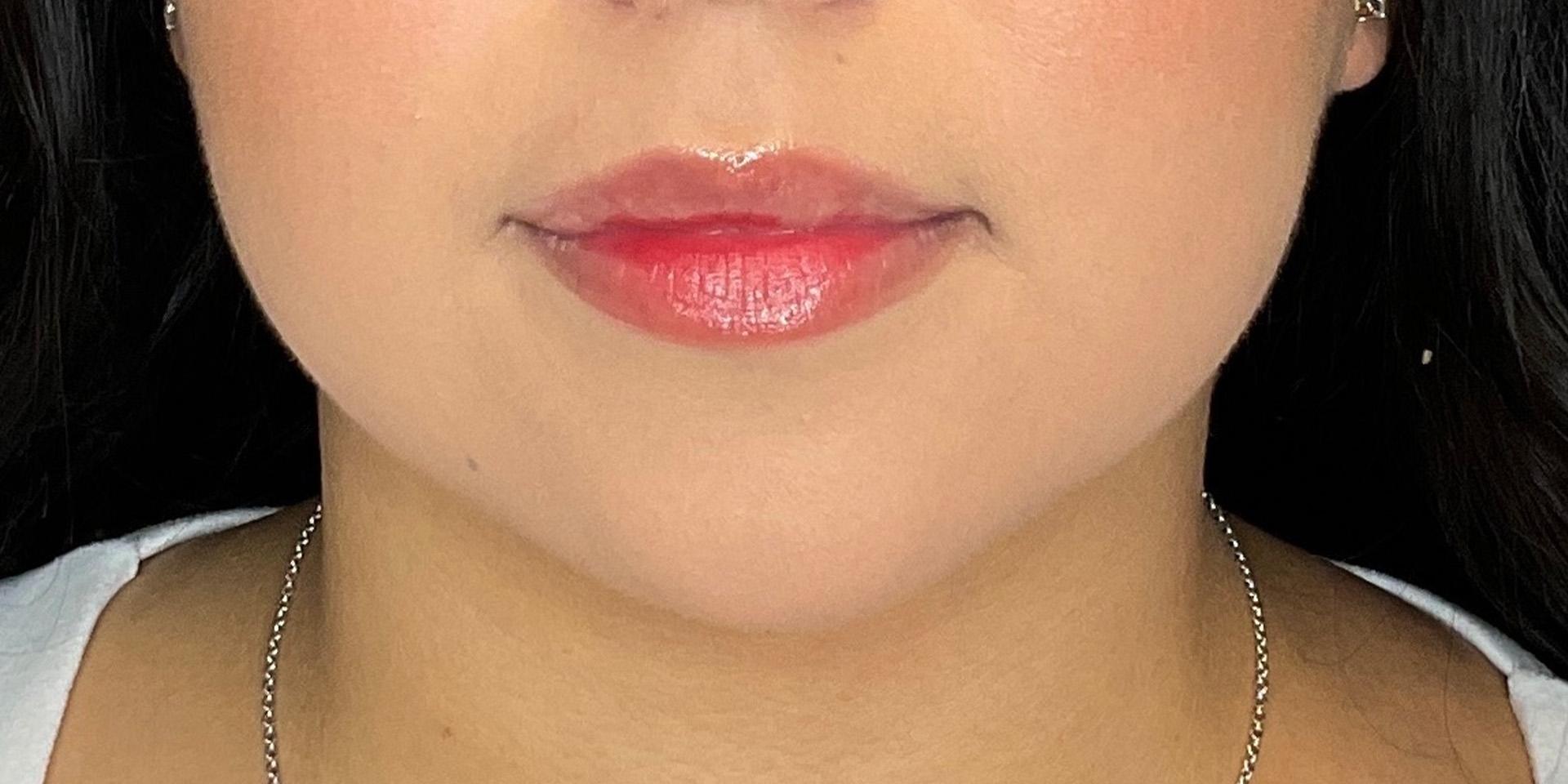 Dr. Courtney lip filler result — Houston, TX