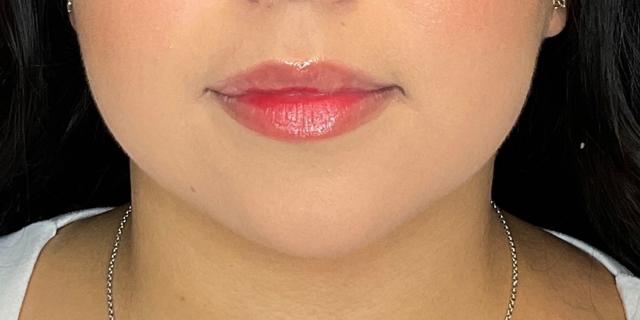 Lip Filler result at Dr. Courtney in Houston, TX