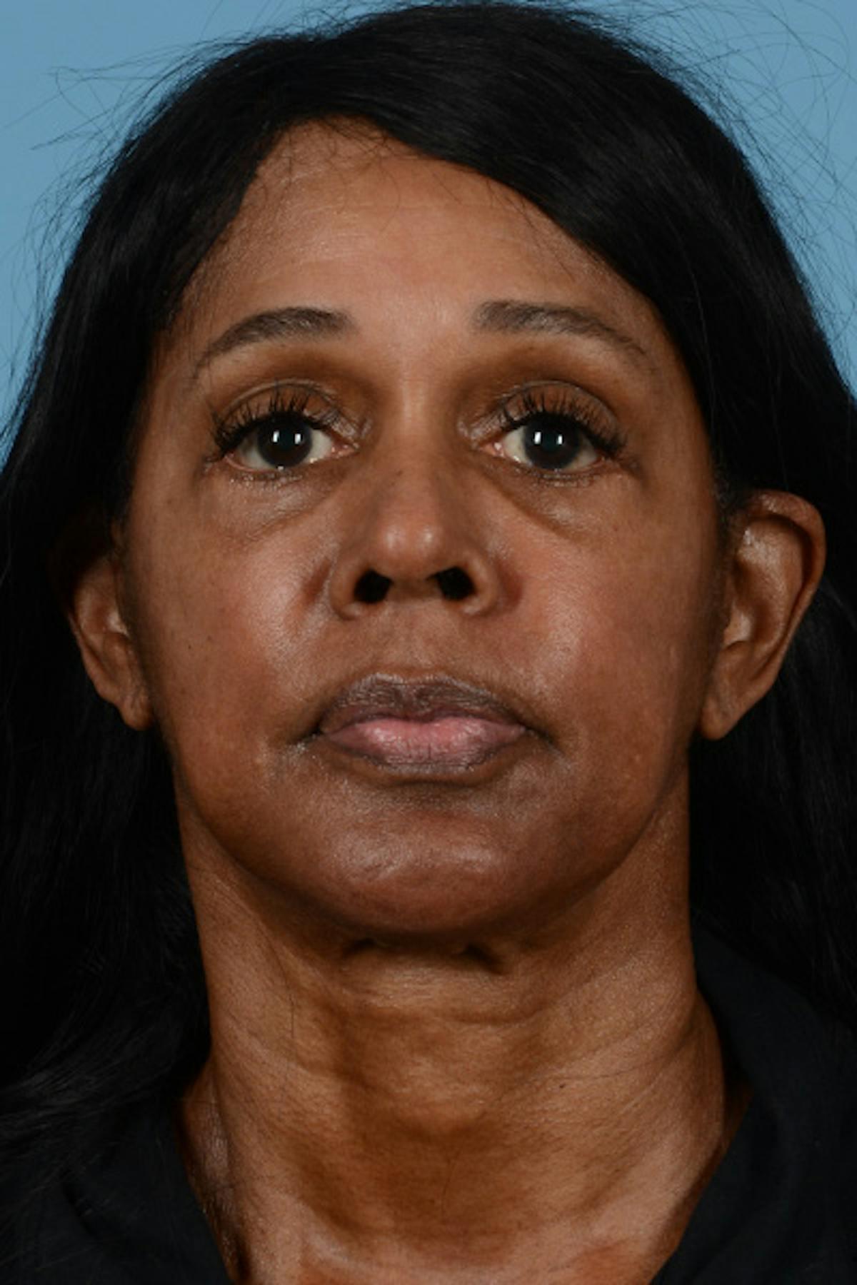 Dr. Courtney facelift after — Houston, TX
