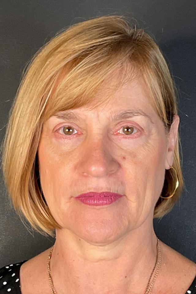 Brow Lift after at Dr. Courtney in Houston, TX