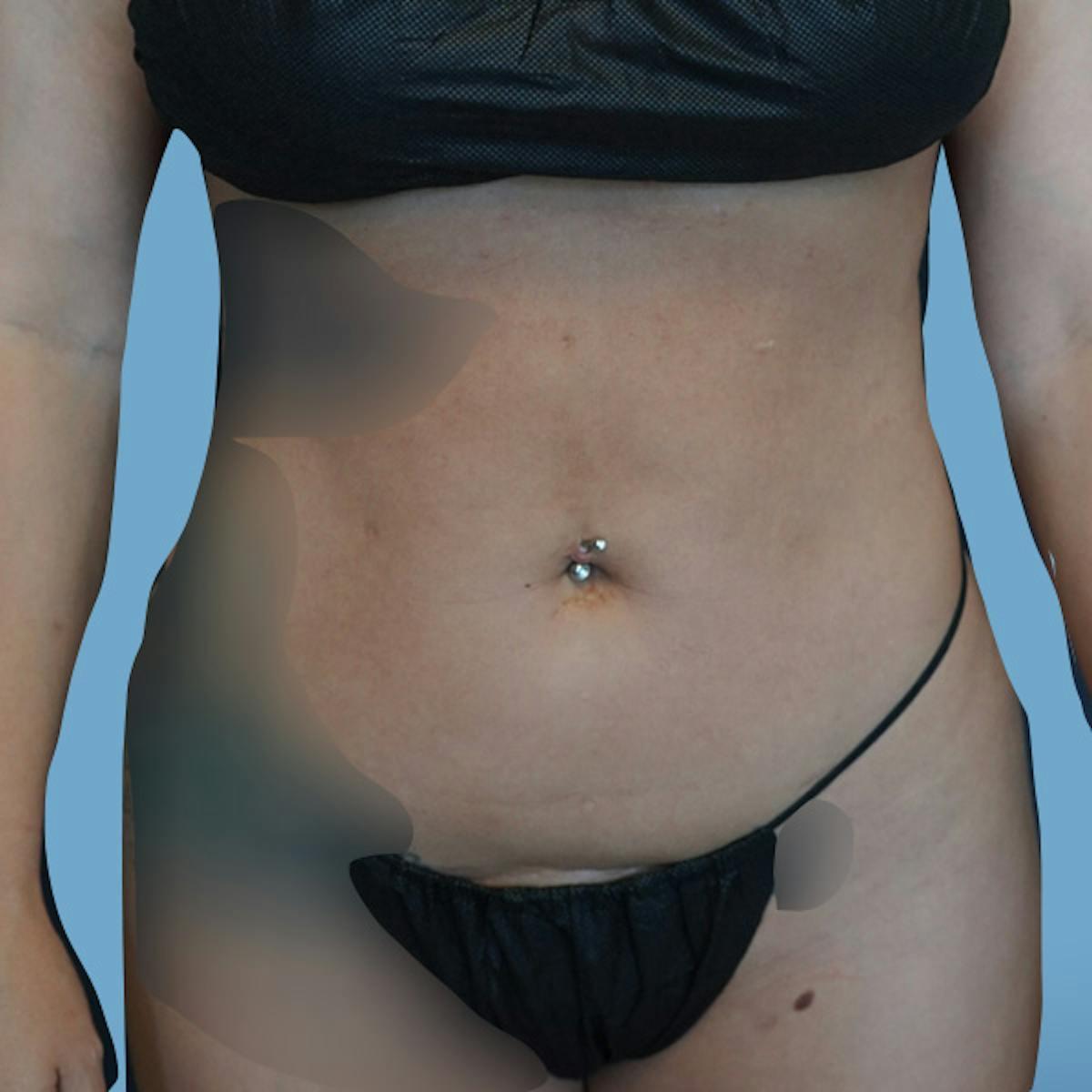 Dr. Courtney liposuction after — Houston, TX