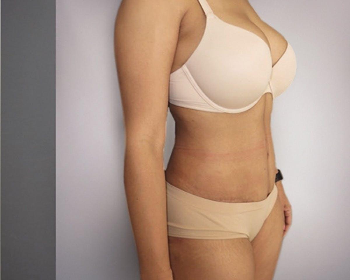 Dr. Courtney tummy tuck after — Houston, TX