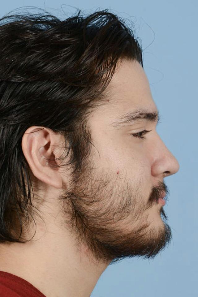 Liquid Rhinoplasty after at Dr. Courtney in Houston, TX