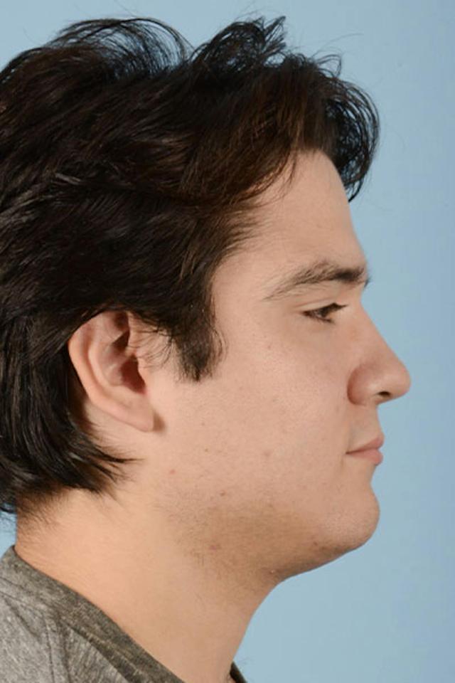 Liquid Rhinoplasty before at Dr. Courtney in Houston, TX