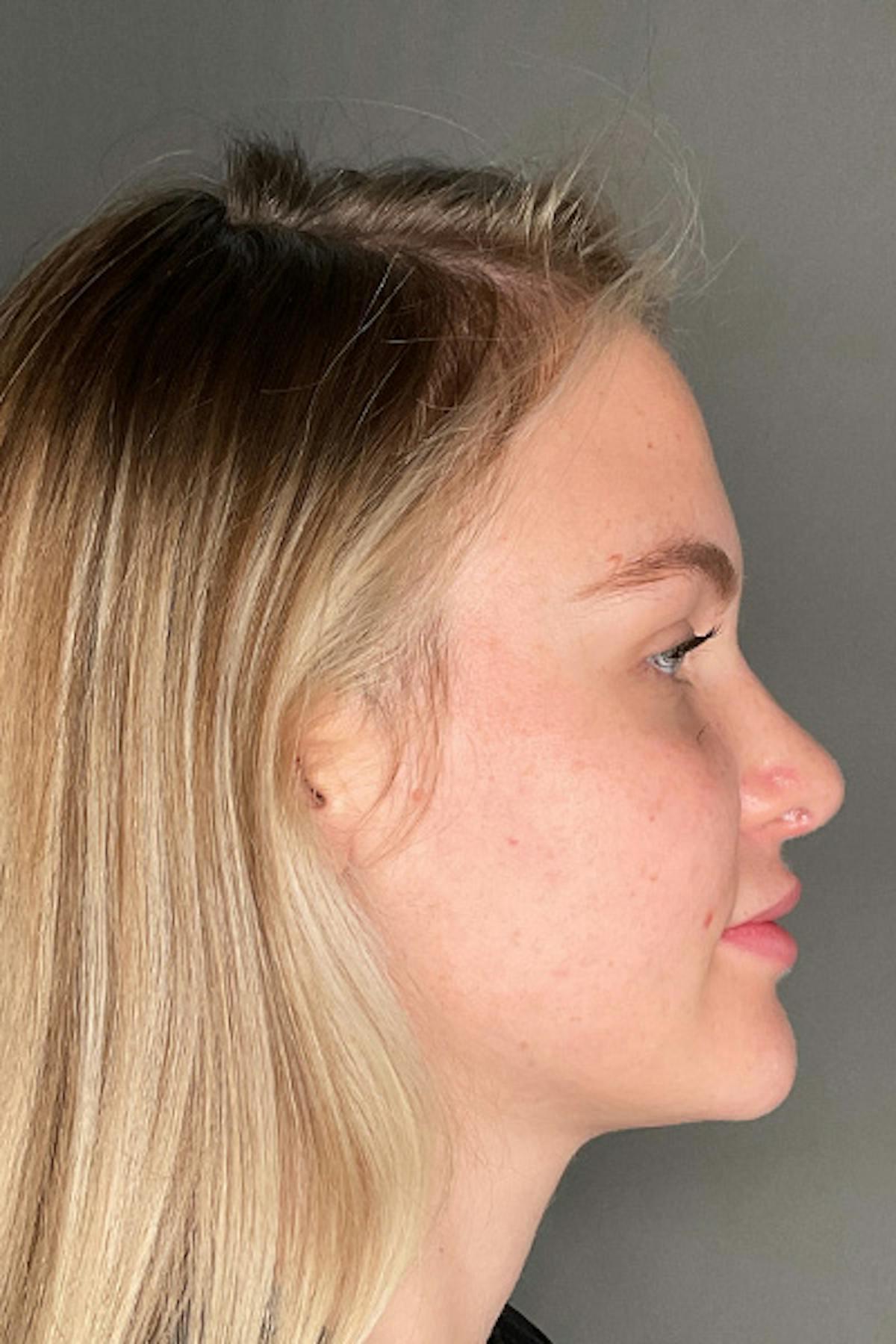 Dr. Courtney rhinoplasty after — Houston, TX